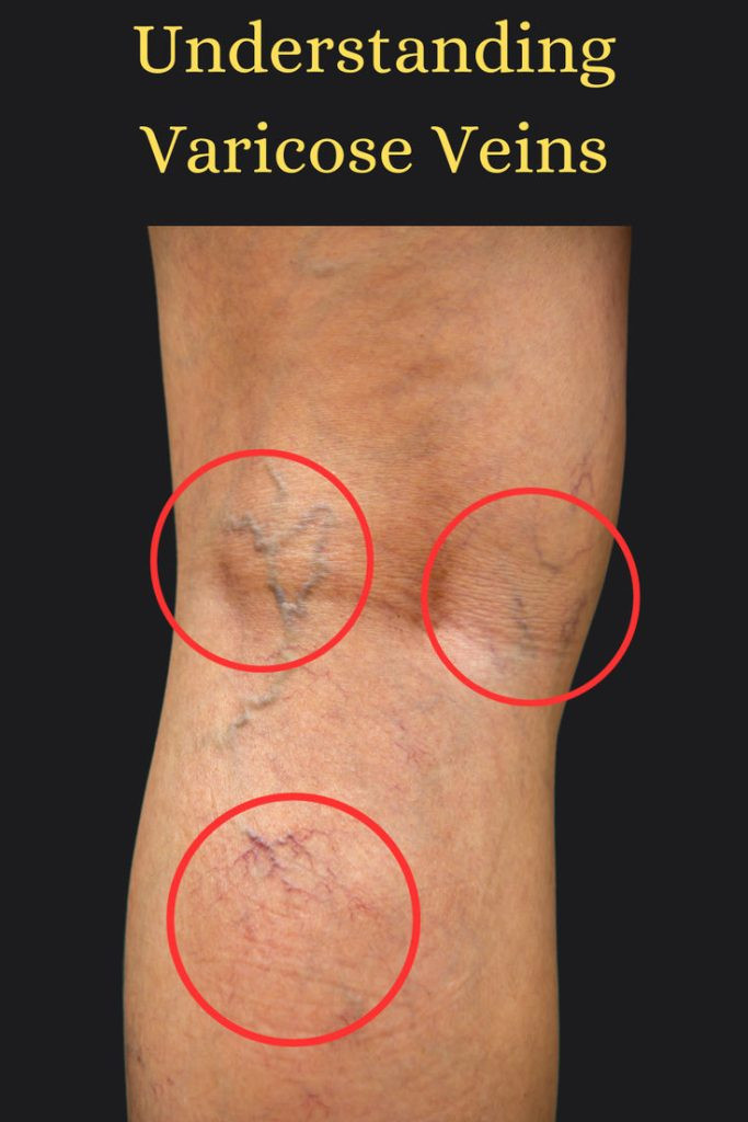 Understanding Varicose Veins: Causes, Treatment, and Recommendations for a Healthier You