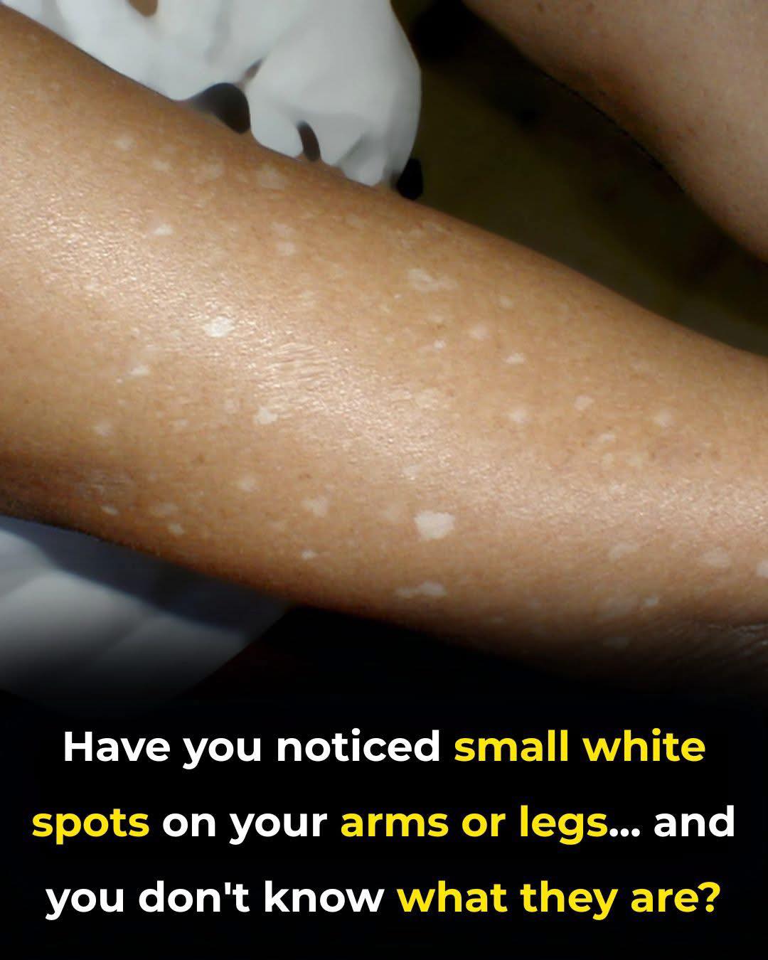Have you noticed small white spots on your arms or legs… and you don’t know what they are? Here’s what a specialist says check 1st comment👇