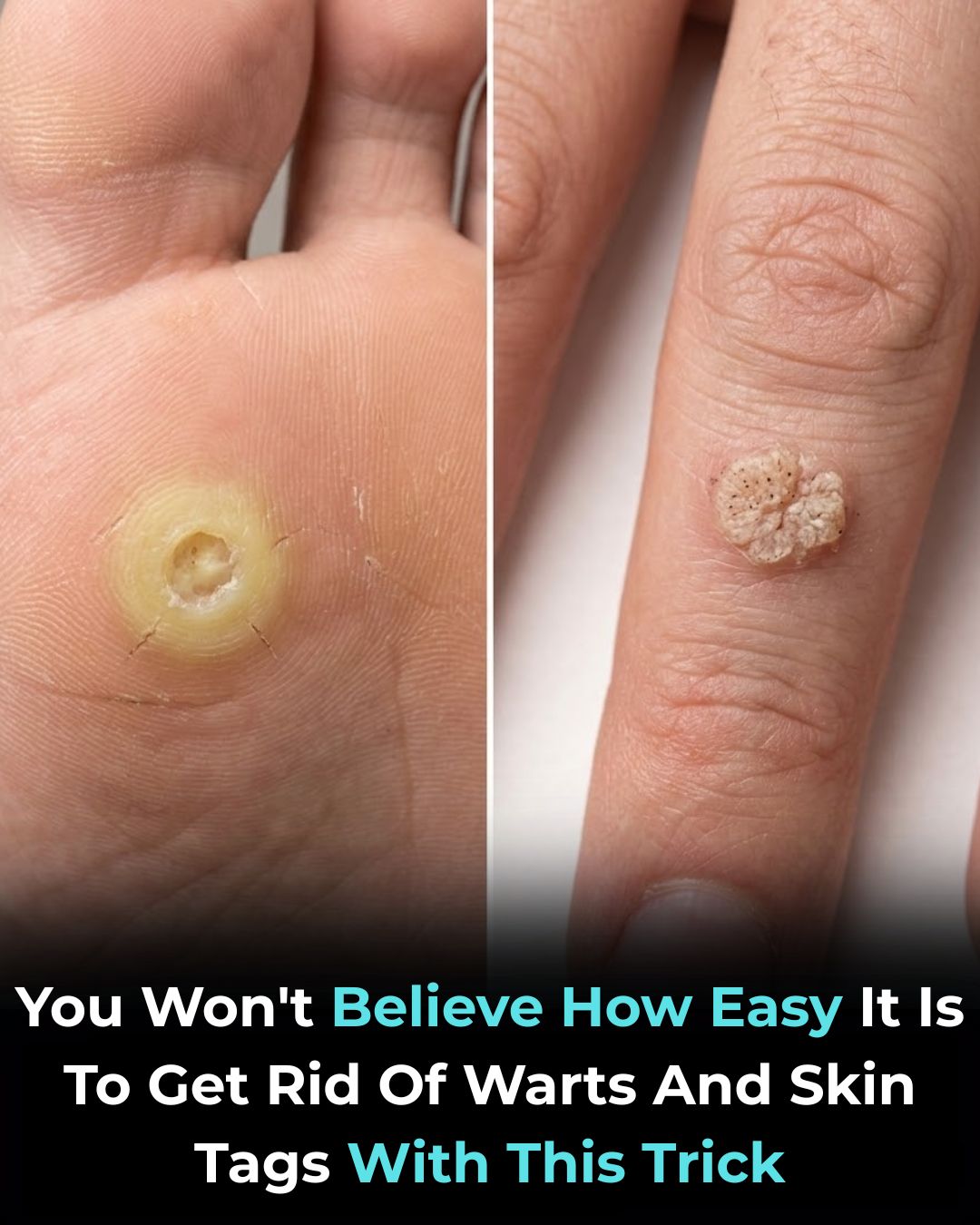How to Remove Skin Tags and Warts with Hydrogen Peroxide